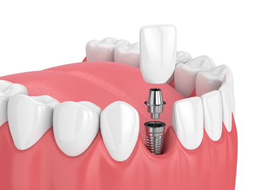 single tooth implants in Greenville, tx